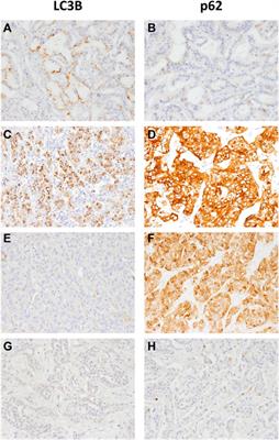 Autophagy Plays a Role in the CUL4A-Related Poor Prognosis of Intrahepatic Cholangiocarcinoma